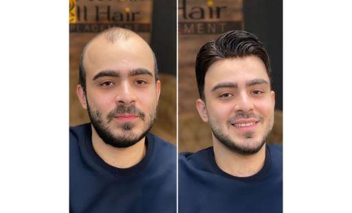 Natural Front Hairline