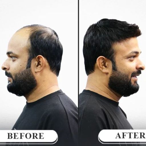 Natural-looking, non-surgical hair replacement